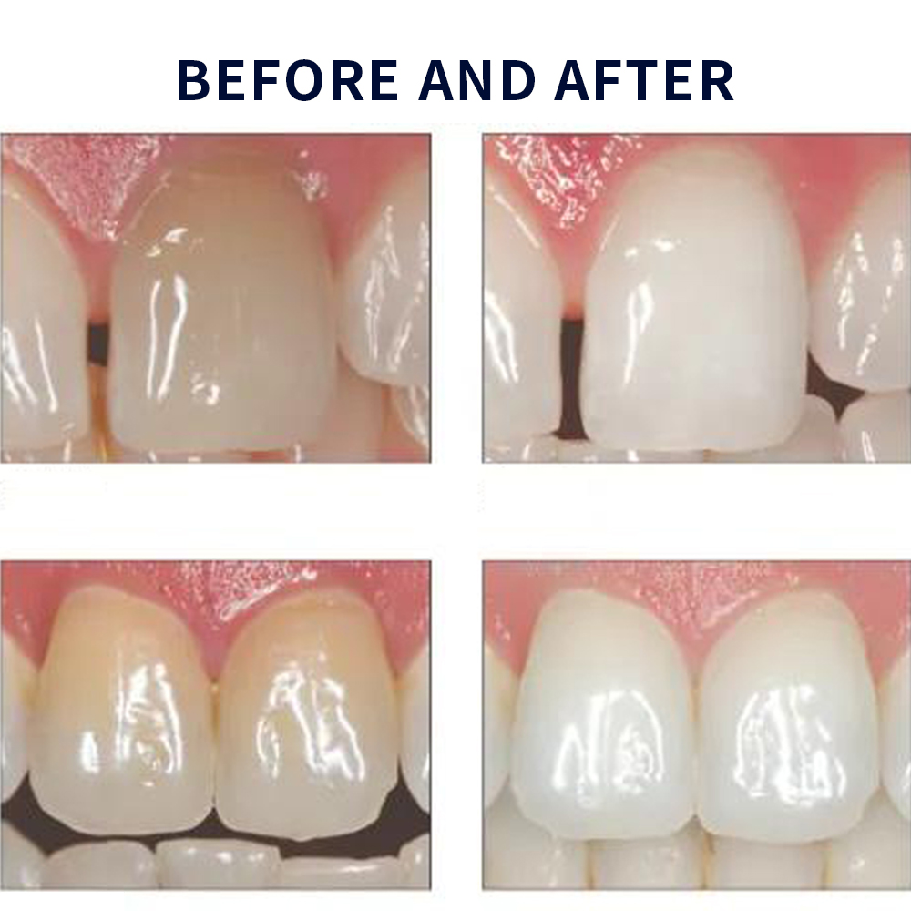 Opalescence Whitening 20% PF 2 - огляд і ціна Teeth Whitening Kit At Home