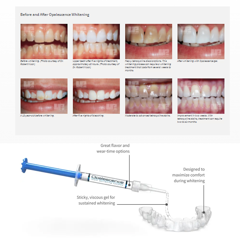 Opalescence Whitening 20% PF 2 - огляд і ціна Teeth Whitening Kit At Home