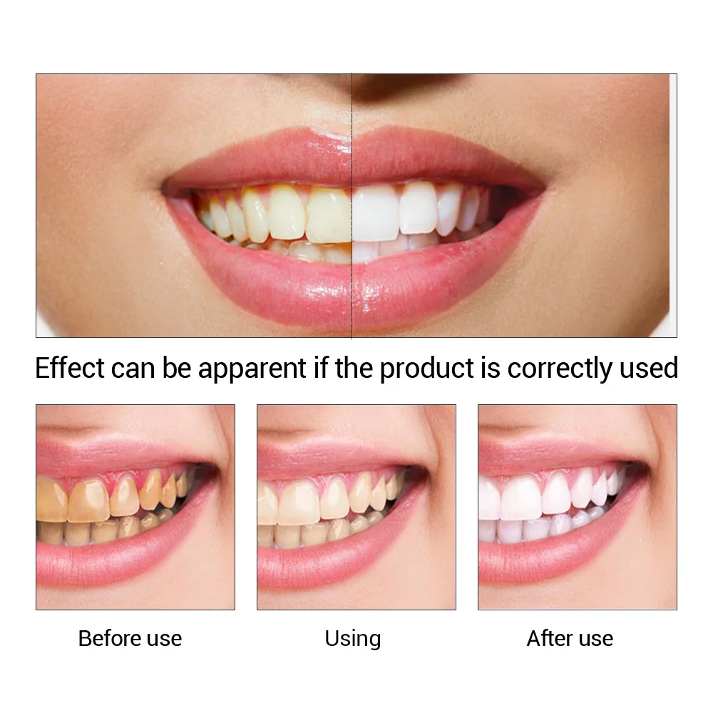 FTEENPLY Teeth Whitening Essen - огляд і ціна Teeth Whitening Ai