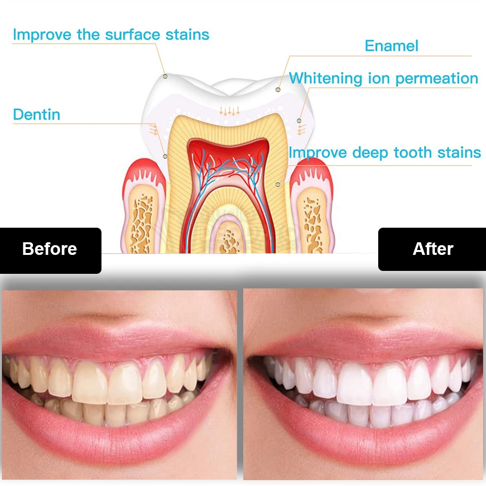 Dental Teeth Whitening Kit Min - огляд і ціна Teeth Whitening Ai